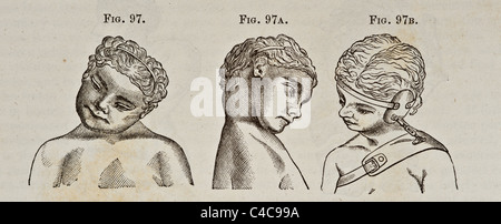 Antike medizinische Illustration, Darstellung der Krümmung der Wirbelsäule Stockfoto