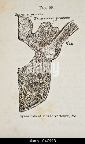 Antike medizinische Illustration, Darstellung der Krümmung der Wirbelsäule Stockfoto