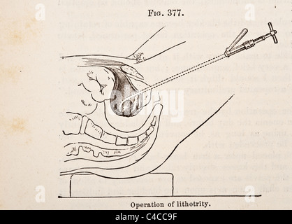 Antike medizinische Illustration der Steinschnittlage ca. 1881 Stockfoto