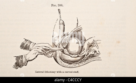 Antike medizinische Illustration der Steinschnittlage ca. 1881 Stockfoto