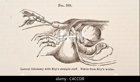 Antike medizinische Illustration der Steinschnittlage ca. 1881 Stockfoto