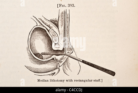 Antike medizinische Illustration der Steinschnittlage ca. 1881 Stockfoto