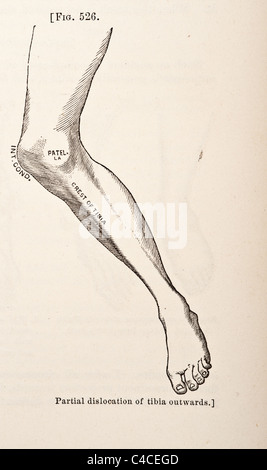 Antike medizinische Illustration mit Luxation des Kniegelenks ca. 1881 Stockfoto