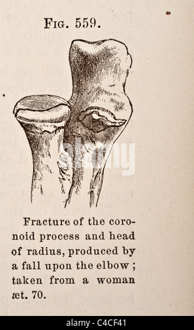 Antike medizinische Illustration von Frakturen des Radius Stockfoto