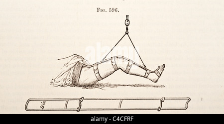 Antike medizinische Illustration von Geräten zur Behandlung von Frakturen ca. 1881 Stockfoto