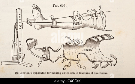 Antike medizinische Illustration von Geräten zur Behandlung von Frakturen ca. 1881 Stockfoto