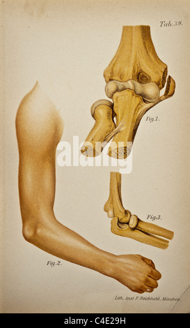 Antike medizinische Illustration einer dislozierten Unterarm; ca. 1902 Stockfoto