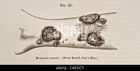 Antike medizinische Illustration der pigmentierten Krebs ca. 1881 Stockfoto