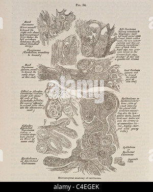 Antike Darstellung der mikroskopischen Anatomie des Karzinoms ca. 1881 Stockfoto