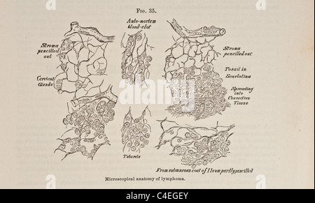 Antike Darstellung der mikroskopischen Anatomie des Lymphoms ca. 1881 Stockfoto