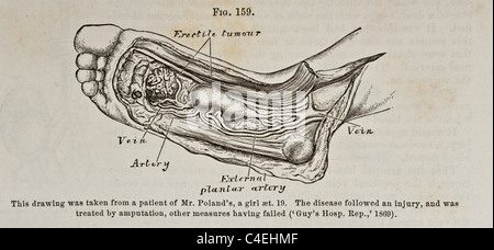 Antike medizinische Illustration des Fußes mit Tumoren ca. 1881 Stockfoto