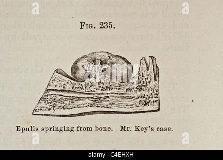 Antike medizinische Illustration der Epulis entstehen aus den Knochen ca. 1881 Stockfoto