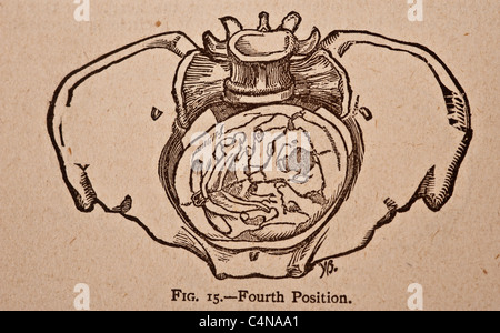 Antike medizinische Illustration der Becken-Knochen Stockfoto