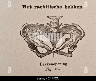 Antike medizinische Illustration der Becken-Knochen Stockfoto