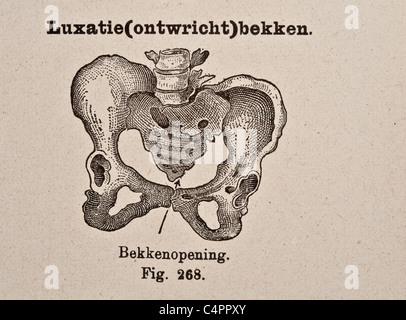 Antike medizinische Illustration der Becken-Knochen Stockfoto