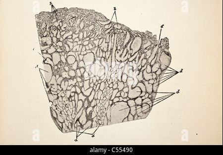 Anatomie der intestinalen Krankheiten einschließlich Krebs Stockfoto