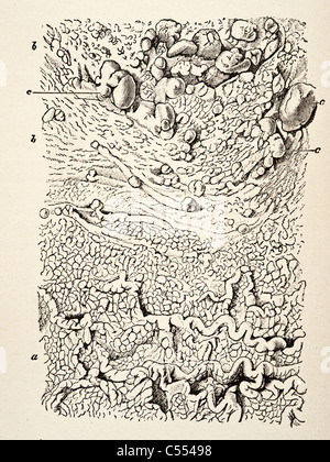 Anatomie der intestinalen Krankheiten einschließlich Krebs Stockfoto