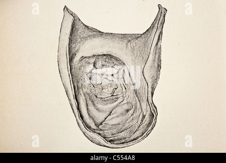 Anatomie der intestinalen Krankheiten einschließlich Krebs Stockfoto