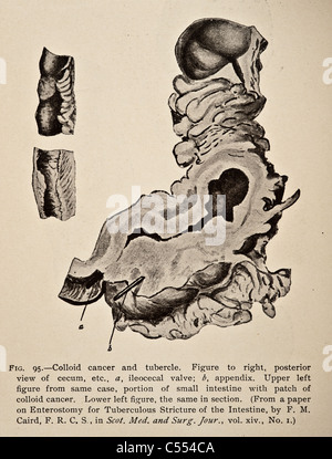 Anatomie der intestinalen Krankheiten einschließlich Krebs Stockfoto