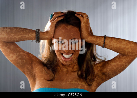 Eine Frau mit einer medizinischen Hauterkrankung, die aussieht wie Vitiligo oder Leucoderma posiert. Stockfoto