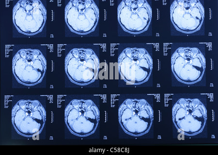 CT-Scan zeigt Querschnitt des menschlichen Kopfes Stockfoto