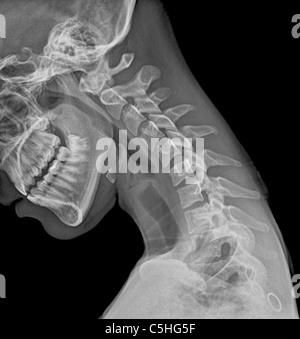 Normale gebeugten Nacken, x-ray Stockfoto