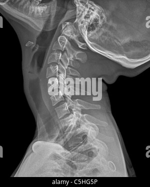 Normale erweitert Hals, x-ray Stockfoto