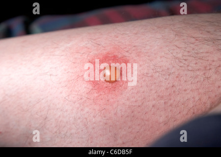 Blister auf einem Bein durch Kratzen einen Mückenstich mans Stockfoto