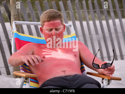 Ein Modell sieht schlecht Sonnenbrand sein, nach dem Einschlafen am Strand.  Sonnenbrand Hand Umriss mit Make-up gemacht. Stockfoto