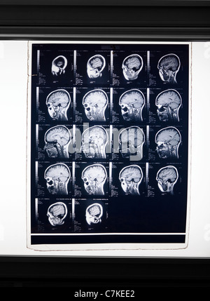 MRI Gehirn-scan Stockfoto