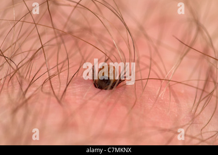 Europäischen Rizinuspflanze Tick - Schafe Zecke Ixodes Ricinus, Fütterung auf der menschlichen Haut Stockfoto