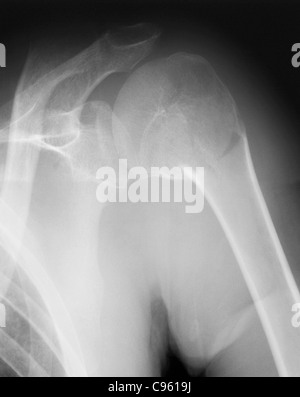 Gebrochene Schulter. Röntgen der Schulter eines Patienten mit einer Fraktur in den Hals des Humerus (Oberarm Knochen). Stockfoto