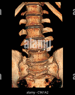 Degenerative Bandscheibenerkrankungen, 3D CT-scan Stockfoto