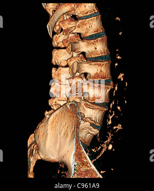 Degenerative Bandscheibenerkrankungen, 3D CT-scan Stockfoto