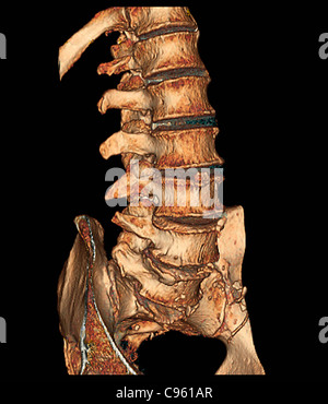 Degenerative Bandscheibenerkrankungen, 3D CT-scan Stockfoto