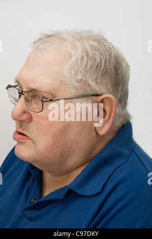 Älterer Mann leidet unter Bell-Lähmung Stockfoto