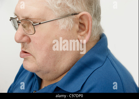 Älterer Mann leidet unter Bell-Lähmung Stockfoto