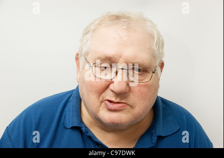 Älterer Mann leidet unter Bell-Lähmung Stockfoto