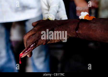 17. Mai 2012 - hat Neu-Delhi, Indien - RAJENDARA, ein Drogenabhängiger, eine Wunde gereinigt und repariert im Yamuna-Basar. Ohne Geld und seinen eigenen Drogen Stahl Rajendara von einem anderen Benutzer, der dann eine Flasche über den Arm brach. Ca. 1.200 Drogenabhängige Leben auf der Strasse in den Basar, ein Gebiet, dass i Stockfoto