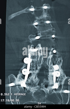 Einzelnen MRI scan der Wirbelsäule mit Schrauben Stockfoto