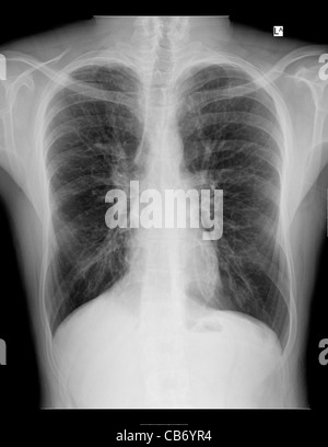 Röntgen-Thorax ein 28 Jahre alten männlichen Patienten leiden unter Atemnot aufgrund von Mukoviszidose und Drogen induzierte Osteoporose Stockfoto