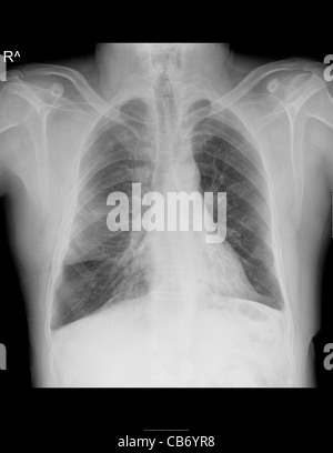 Röntgenaufnahme eines 44 Jahre alten männlichen Patienten mit zystischer Fibrose (CF) mit pulmonaler Manifestation Stockfoto