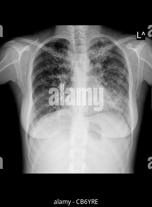 Röntgen-Thorax einer 25 Jahre alten Patientin Dyspnoe verursacht durch Mukoviszidose leiden Stockfoto