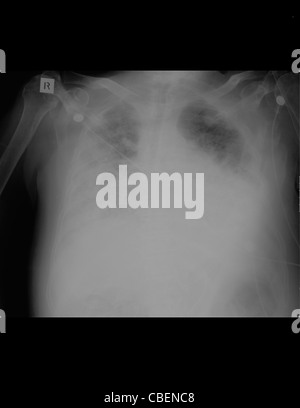 Röntgen-Thorax einer 84 Jahre alten männlichen Patienten metabolische Azidose und Obstruktion der Atemwege chronische Leiden Stockfoto