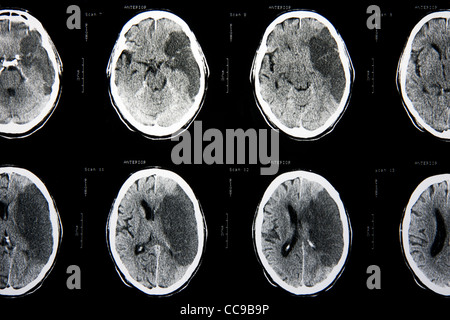 Cat-Scan des Gehirns Stockfoto