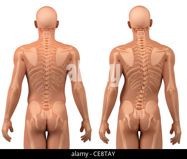 Skoliose. Computer Kunstwerk eine gesunde Wirbelsäule (links) und eine Wirbelsäule mit eine seitliche Krümmung (Skoliose). Stockfoto