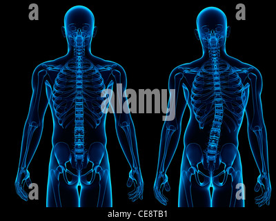 Skoliose. Computer Kunstwerk eine gesunde Wirbelsäule (links) und eine Wirbelsäule mit eine seitliche Krümmung (Skoliose). Stockfoto