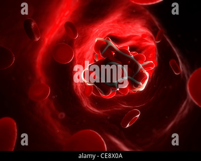 Blutgerinnsel. Computer-Artwork von roten Blutkörperchen, gefangen in einem Fibrin-Protein-Netz in einer Arterie. Stockfoto