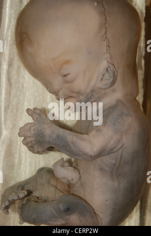 Pätau-Syndrom Fetus (Fötus). Pätau-Syndrom Baby Fötus original Exemplar erhalten in Medical College Hospital, Kerala, Indien Stockfoto