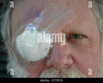 älterer Mann trägt eine Augenklappe Plastikbecher nach einer Kataraktoperation Stockfoto